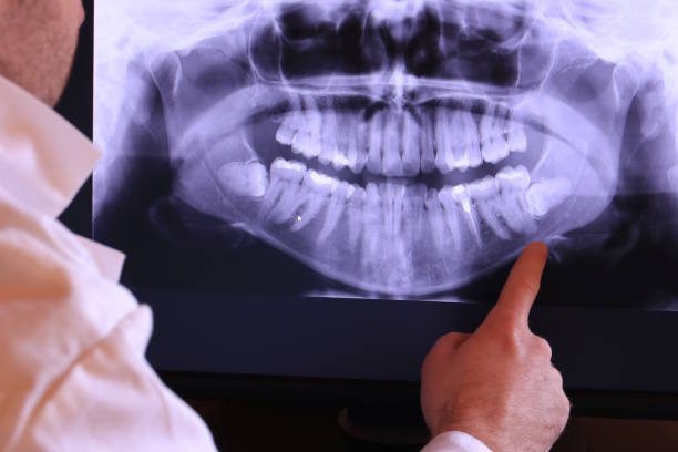 Best Emergency Dentist for Lost Fillings or Crowns in St Charles, MO