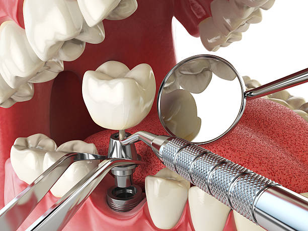 Best Urgent Dental Care for Toothache in St Charles, MO